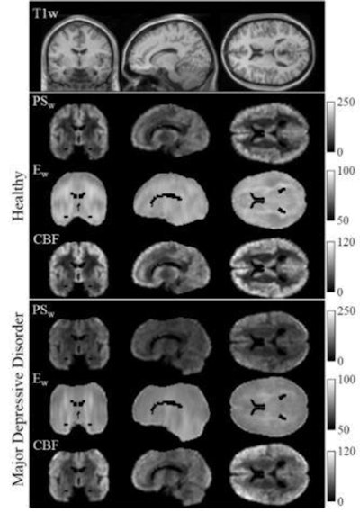 MRI brain scans using the newly developed IDEALS technique shows the difference between normal brains and patients with major depressive disorder. Images courtesy of RSNA.