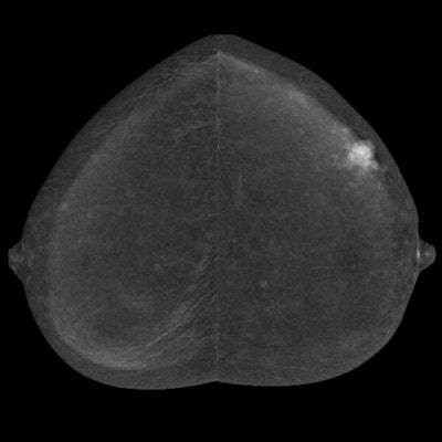 CMIST asks if CESM screening provides more accurate cancer detection than current screening methods in women with dense breasts. Image courtesy of the ACR.