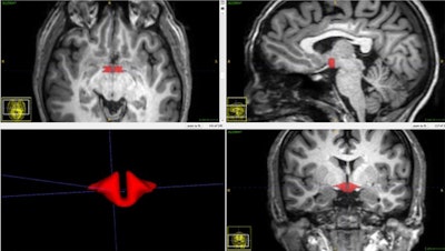 Brain MRI depicts hypothalamus in red.