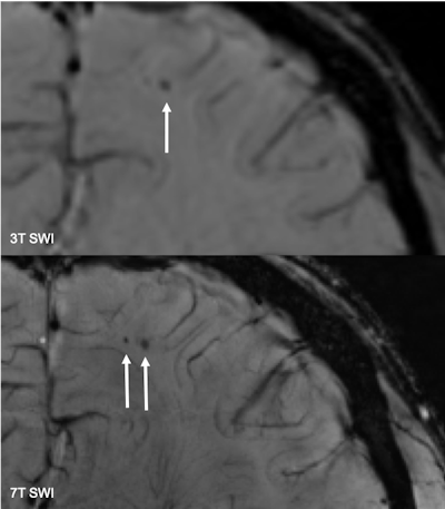 Seven-tesla MRI with SWI enables higher resolution and a more accurate identification and detection of cerebral microbleedings (bottom, arrows), compared with 3-tesla SWI (top, arrow). Images courtesy of Dr. Cornelius Deuschl.