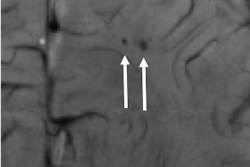 2019 12 04 23 23 0630 Afp 7 T Microbleeds Deuschl Rsna 20191204232053