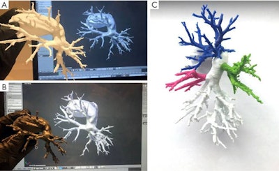 Patient-specific 3D-printed models of the pulmonary arteries and surrounding structures fabricated with white polylactic acid (A), flexible resin (B), and multipart polylactic acid (C). All images courtesy of Dr. Jan Witowski.