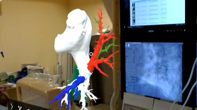 Augmented reality model of the pulmonary arteries and surrounding structures used to facilitate a percutaneous coronary intervention.