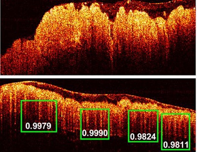 The OCT imaging detected images of colon cancer (top photo) and normal colon tissue. The green boxes indicate the scores of probability of the predicted 'teeth' patterns in the tissue. Image courtesy of Zhu Lab.