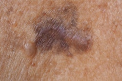 2019 12 11 00 07 4491 Skin Cancer 400