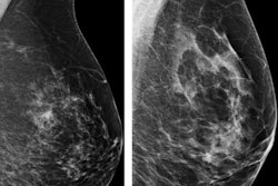2019 12 13 22 13 8772 2019 12 17 Breast Ai Thumb