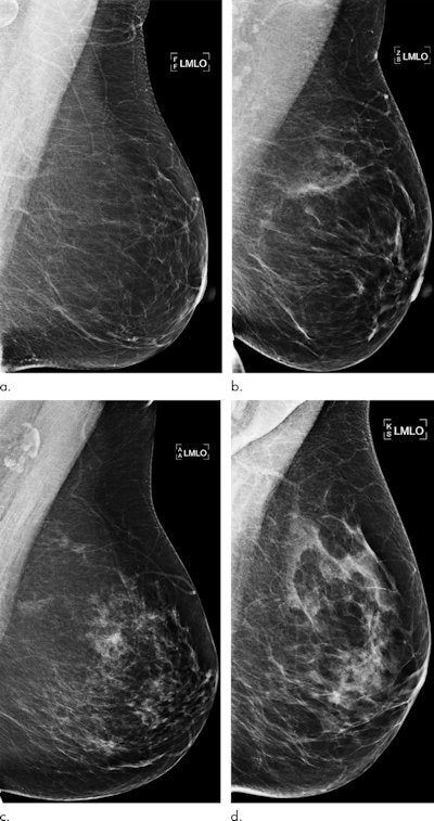 Examples of mammograms with concordance between the deep-learning risk score and the outcome of breast cancer (true predictions). All images are mediolateral oblique views of the left breast. (a) Mammogram in a 55-year-old woman with a low deep-learning risk score (0.05) who was not diagnosed with breast cancer (i.e., true-negative prediction). (b) Mammogram in a 47-year-old woman with a low deep-learning risk score (0.06) who was not diagnosed with breast cancer (i.e., true-negative prediction). (c) Mammogram in a 56-year-old woman with a high deep-learning risk score (0.30) who received a diagnosis of breast cancer 5.1 years after the examination (i.e., true-positive prediction). (d) Mammogram in a 57-year-old woman with a high deep-learning risk score (0.30) who received a diagnosis of breast cancer 5.0 years after the examination (i.e., true-positive prediction). All images courtesy of Radiology.