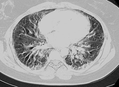 Images from the chest CT scans of a 25-year-old woman who had been vaping. Above: upon initial presentation to the emergency department. Below: several days later, after developing ARDS. Images courtesy of Dr. Nicole Sakla.