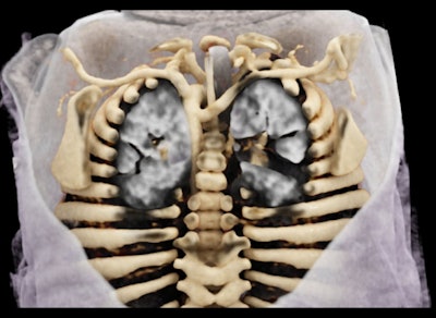 The cinematic rendering shows a posterior view of an aberrant right subclavian artery coursing to the enteric tube, which is difficult to see using conventional CT and volume rendering. Image courtesy of Dr. Hannah Recht.