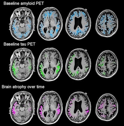 Images show four sequential cross sections of a single study participant's brain (left to right = bottom to top) to illustrate that the relationship between amyloid, tau, and future brain degeneration is similar across the brain, not just in the single cross sections shown in the other figures. Images courtesy of UCSF and Rabinovici et al.