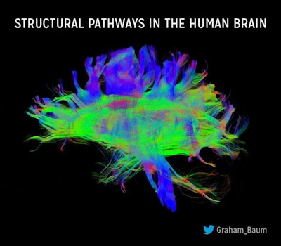 A study examining the relationship between structural and functional brain connectivity in 727 participants ages 8 to 23 used MRI protocols to reveal marked remodeling of structure-function coupling during youth. Image courtesy of Graham Baum.