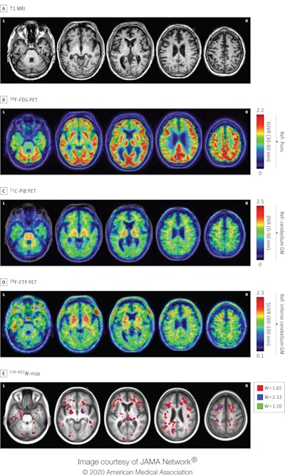 2020 01 03 23 37 1761 2020 01 06 Flortaucipir Pet