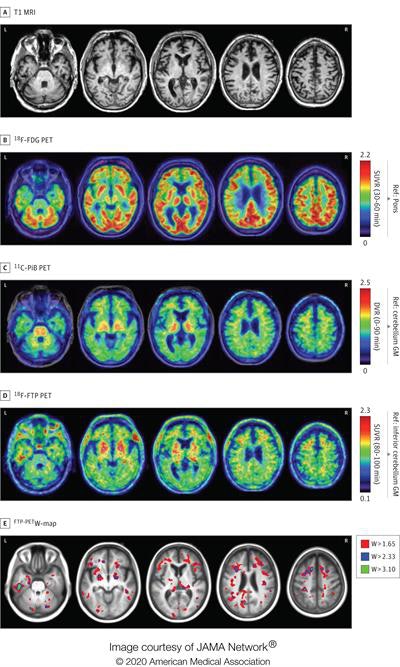 2020 01 03 23 37 1761 2020 01 06 Flortaucipir Pet 20200103235514
