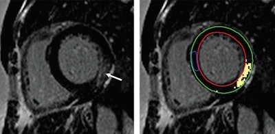 MR images of a 45-year-old woman with Fabry disease who experienced unsustained ventricular tachycardia following cardiac MRI. Basal short-axis late gadolinium-enhanced (LGE) cardiac MRI (left) demonstrates midwall enhancement most prominent at basal inferior lateral wall (arrow). Basal short-axis LGE image demonstrates (right) quantification of LGE (epicardial contour [green], endocardial contour [red], normal reference myocardium contour [blue], and extent of LGE with signal intensity threshold of 4 standard deviations above visually normal myocardium [yellow]). Images courtesy of Radiology.