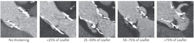 4D CT scans showing varying degrees of hypoattenuated leaflet thickening. Image courtesy of the New England Journal of Medicine. © 2020.