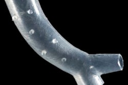 2020 01 13 17 38 0908 Cleveland Clinic Stent 400 Thumb