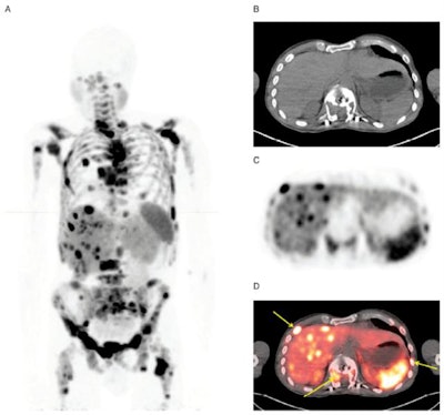 Maximum-intensity projection images with Cu-64 DOTATATE PET/CT are from a patient with metastatic bronchial carcinoid and extensive metastatic disease, including multiple small liver metastases (A). Corresponding CT image (B), PET (C), and fused PET/CT (D) show multiple bone metastases (yellow arrows). Images courtesy of JNM.