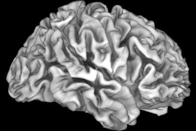 Brain MR image shows that the cortex is adversely affected by the high risk of lead exposure in children from lower-income families. Images courtesy of Marshal et al and Children's Hospital Los Angeles.