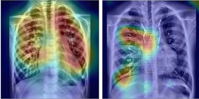 Left: Deep-learning analysis of chest radiograph shows increased pulmonary to systemic blood flow ratio. Right: Analysis shows decreased pulmonary to systemic flow ratio. Image courtesy of JAMA Network.