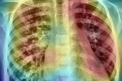 2020 01 22 17 04 8217 2020 01 22 X Ray Ai Image 20200122175703