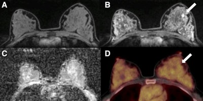 A 50-year-old postmenopausal woman with fibroadenoma (arrows) in left breast. (A) Unenhanced fat-saturated T1-weighted MRI shows extreme amount of fibroglandular tissue (ACR d). (B) Moderate background parenchymal enhancement is seen on dynamic contrast-enhanced MRI at 90 sec. (C) Mean ADC of breast parenchyma of contralateral breast on diffusion-weighted imaging with ADC mapping is 1.5 x 10-3 mm2/sec. (D) On F-18 FDG PET/CT, lesion is not F-18 FDG-avid, and background parenchymal uptake of normal breast parenchyma is relatively high, with SUVmax of 3.2.