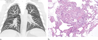 Maximum intensity projections of the CT data of a 32-year-old man with a history of vaping show diffuse centrilobular nodularity (a). Histologic sections of the patient's transbronchial cryobiopsy show a micronodular pattern of airway-centered organizing pneumonia that corresponds to the centrilobular nodularity seen on CT (b). All images courtesy of the RSNA.