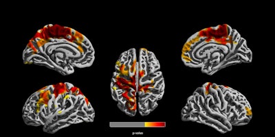 MR images show clusters of reduced cortical thickness among children highly exposed to air pollution, compared with lower-exposed children. The differences were seen in both left and right brain hemispheres. Image courtesy of PLOS One.
