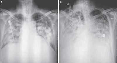 Chest radiographs of a patient with the coronavirus show bilateral fluffy opacities on day 8 (A) with increased density, profusion, and confluence, as well as accumulation of pleural liquid on day 11 (B). Image courtesy of NEJM. © 2020.