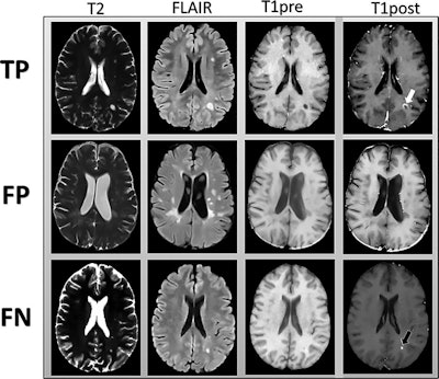 MR images are examples of T2-weighted, fluid-attenuated inversion-recovery (FLAIR), and precontrast T1-weighted images input into the deep-learning model. Postcontrast T1-weighted images (T1post) demonstrate areas of true-positive (white arrow) and false-negative (black arrow) enhancement. FN = false-negative classification of enhancement, FP = false-positive classification of enhancement, TP = true-positive classification of enhancement. Images courtesy of Radiology.