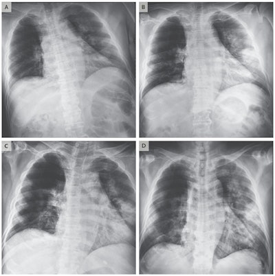 Chest radiographs obtained at admission (A) and on day 3 (B) of man who had traveled to Wuhan. Image C was acquired on day 5 and image D on day 6. Images courtesy of New England Journal of Medicine.