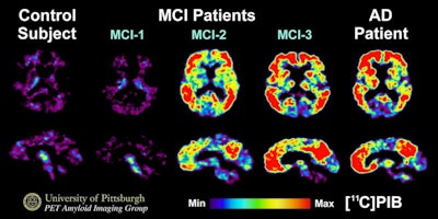 PET images were performed with carbon-11 labeled Pittsburgh Compound B (C-11 PiB) on normal control subjects (far left), three different patients with mild cognitive impairment (MCI) (center images) and a patient with mild Alzheimer's disease (far right). Some patients with MCI have amyloid levels similar to control subjects, while some amyloid levels in MCI patients resemble Alzheimer's conditions. Images courtesy of Dr. William Klunk, PhD, and the University of Pittsburgh.