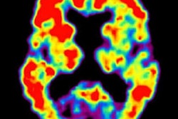 2020 01 30 00 34 2553 2020 01 30 Amyloid Pet Thumb