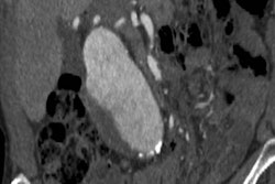 2020 01 30 01 39 0643 2020 01 30 Ct Aneurysm Thumb