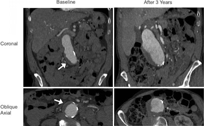 Contrast-enhanced CT scans of an 85-year-old male with a blood clot (arrows) show the growth of an abdominal aortic aneurysm from 4.1 cm to 6.3 cm within three years. Image courtesy of the RSNA.