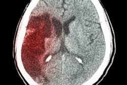 2020 01 30 19 39 6619 Ct Brain Stroke3 400
