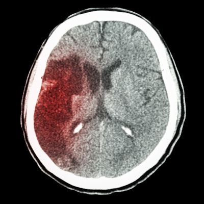 2020 01 30 19 39 6619 Ct Brain Stroke3 400