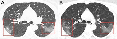 CT scan of a 33-year-old woman infected with the novel coronavirus shows multiple bilateral ground-glass opacities evident on the initial scan (A) and progressive ground-glass opacities, without subpleural sparing, on a scan obtained three days later (B). Image courtesy of the RSNA.