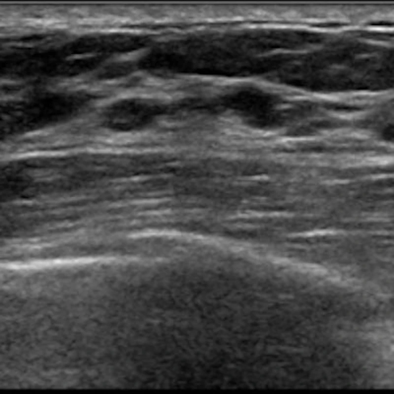 Microcysts Most cysts found on breast ultrasound don't need biopsy | AuntMinnie