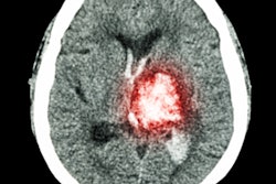 2019 12 18 00 08 6648 Ct Brain Stroke 400