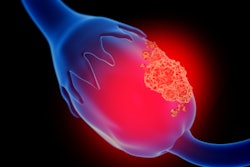 2020 01 31 23 45 3286 Ovarian Cancer2 400