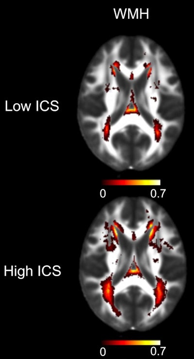 MRI scans showing the average measurable difference in white-matter brain damage in people with low inflammatory blood test scores (below median) and those with high scores (above median). WMH = white-matter hyperintensities; ICS = inflammatory composite score. Image courtesy of UCLA Health.
