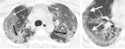 CT scans of a 29-year-old male with the novel coronavirus showing diffuse bilateral confluent and patchy ground-glass opacities and consolidative opacities (left). A zoomed-in look of the right middle and lower lobes shows striking peripheral distribution (right). Image courtesy of the RSNA.