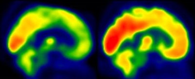 FDG-PET images represent brain glucose metabolism from a subject with low levels of physical activity group (left) and from a participant in the moderate-intensity aerobic training group (right). Red areas show greater degrees of brain glucose metabolism. Images courtesy of Brain Plasticity.