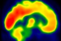 2020 02 05 17 26 2012 2020 02 06 Fdg Pet Exercise Brain Activity Thumb