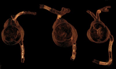3D CT visualization of personalized 3D-printed coronary models, with coronary stents in the main left and right coronary arteries simulating coronary stenting. Image courtesy of Zhonghua Sun, PhD.