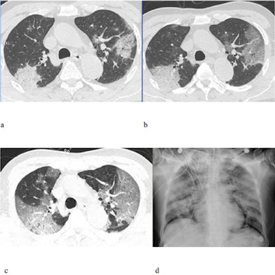 CT scans of a 71-year-old male with the novel coronavirus showing ground-glass opacities with consolidation and reticular and/or interlobular septal thickening upon admission (a), two days later (b), and four days later (c). A chest x-ray obtained six days after admission shows diffusely increased opacities in both lungs (d). Image courtesy of the RSNA.