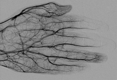 Digital subtraction angiography image obtained approximately 24 hours after 1 mg/h IA tPA infusion, 500 U/h heparin via peripheral IV, and daily oral aspirin (81 mg) shows improved perfusion of digital arteries, albeit with suboptimal vascular blush of distal second and third phalanges. All images courtesy of the American Journal of Roentgenology.