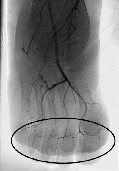 DSA image of right foot obtained approximately 24 hours after infusion of 1 mg/h intraarterial tPA, concomitant systemic IV heparin (500 U/h), and daily 81 mg aspirin shows marked interval pedal digital revascularization, with reappearance of digital arteries (oval).