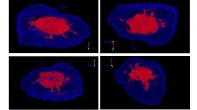 3D micro-CT visualization of breast tissue biopsy samples. Higher regions of x-ray absorption indicate cancer (red) and regions of lower x-ray absorption represent noncancerous tissue (translucent, blue). Image courtesy of James Michaelson, PhD.