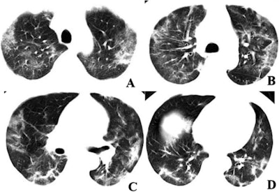Chest CT scans of a 60-year-old male with COVID-19 showing multifocal ground-glass opacities and mixed consolidation in the peripheral area of both lungs. DNA tests returned negative for 2019-nCoV until the eight day after presentation. Image courtesy of the RSNA.